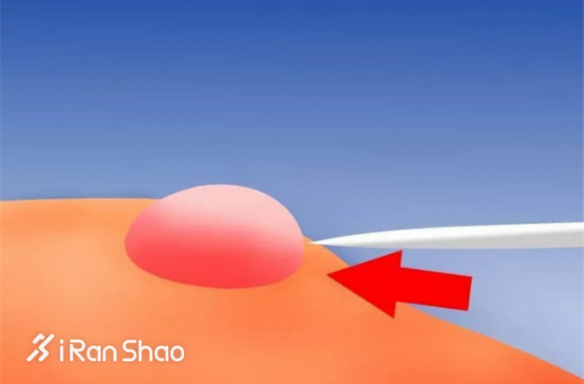 怎么分辨水泡是什么原因引起的,大水泡的症状及治疗方法