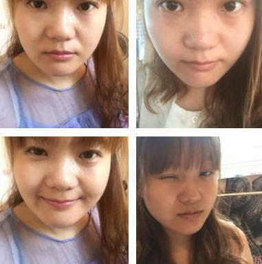 割双眼皮的危害和后遗症,拆双眼皮线痛吗