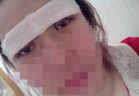 长期用双眼皮胶水变松,长期用胶水粘双眼皮的后果