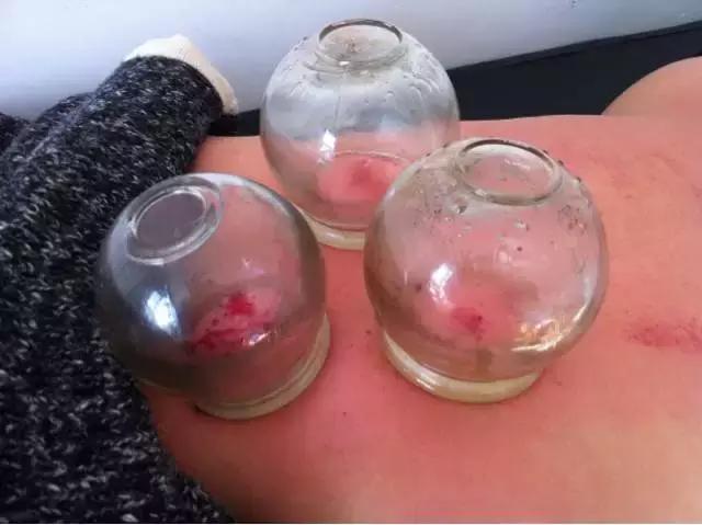 腰突导致腰肌劳损怎么治疗,腰肌劳损的保守治疗方法是什么