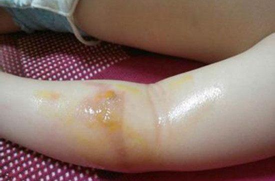 宝宝发烧39.8头很烫很烫怎么办,宝宝再也不怕被烫到了