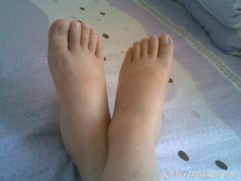 孕期妊娠反应最严重是什么状态,妊娠期的常见疾病识别及预防