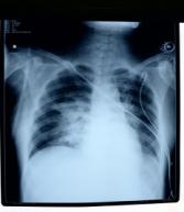 酒精中毒引起的末梢神经炎怎么治,酒精中毒要怎么治