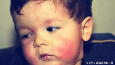 宝宝湿疹老不好，一查过敏源居然是牛奶，怎么办？