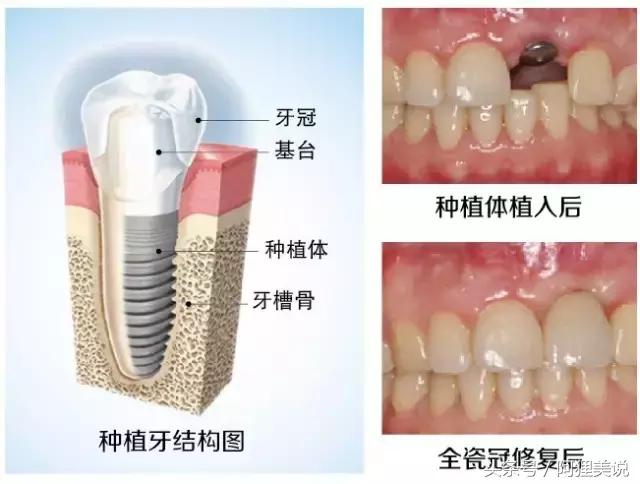 种植牙和义齿成本价,假牙种植牙烤瓷牙哪个更舒服