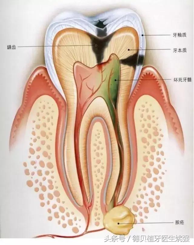 补牙竟然不能一次完成？