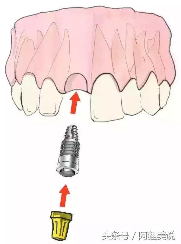 种植牙和义齿成本价,假牙种植牙烤瓷牙哪个更舒服