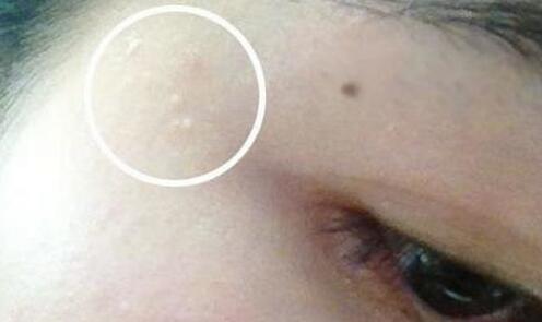 长脂肪粒是皮肤屏障受损吗,长脂肪粒是因为胖吗