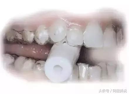 隐适美隐形矫正摘戴、保养注意事项全攻略