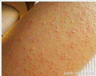 果酸焕肤精华液与果酸的区别,什么样的人需要果酸换肤