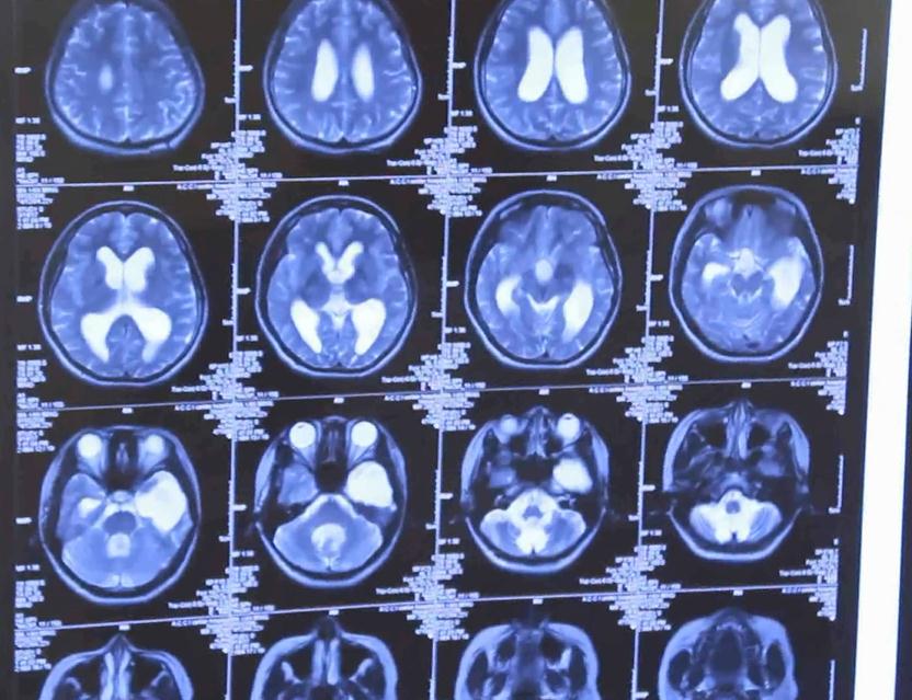 全世界哪里能根治癫痫啊,癫痫二十年的求医之路