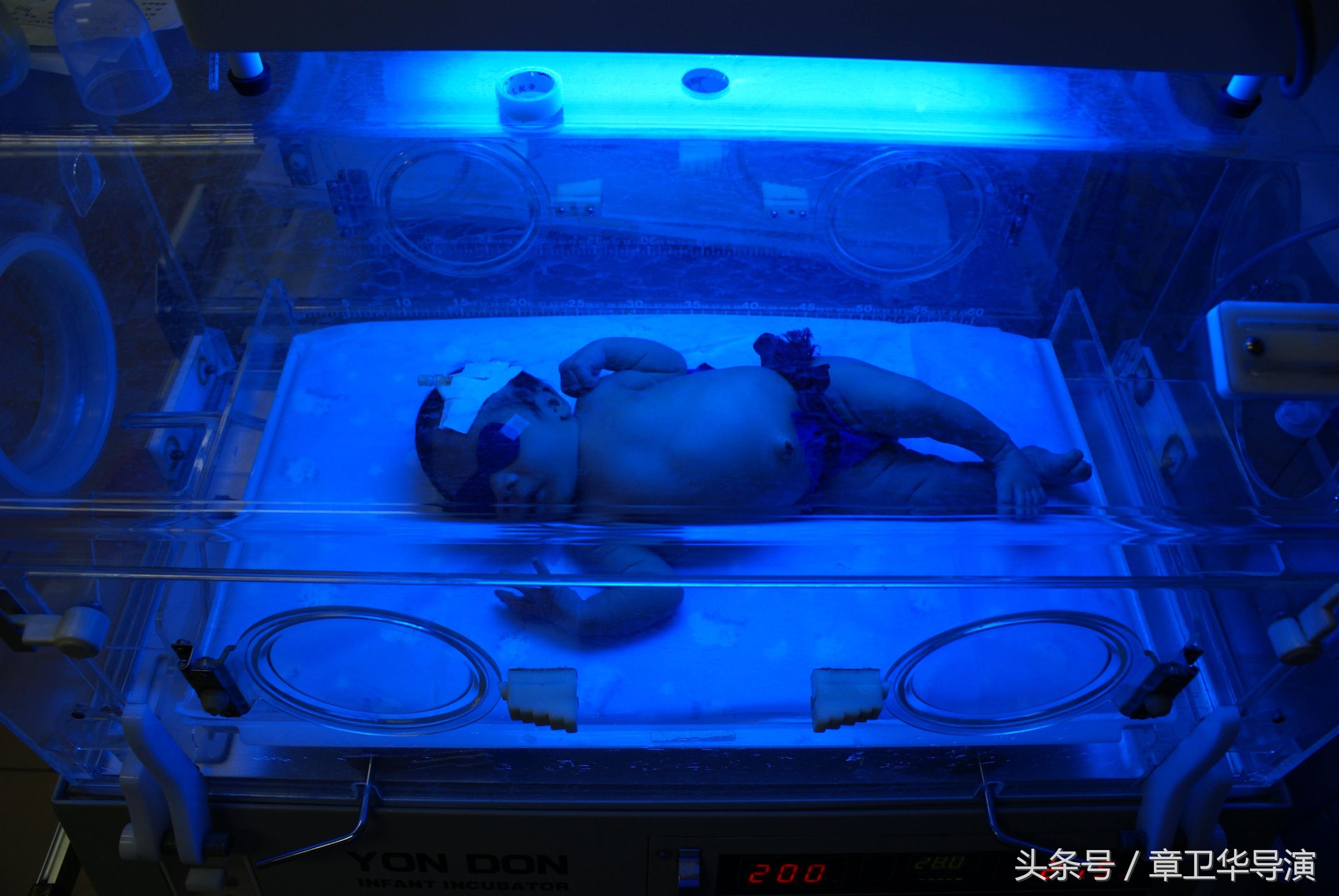 新生儿黄疸跟宝妈饮食有关系吗,新生儿黄疸持续多久会造成脑损伤