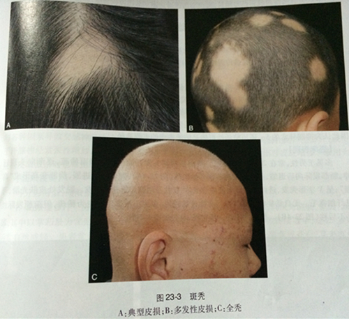 黑芝麻每天吃多少合适治疗脱发 (脂溢性脱发吃黑芝麻有效吗)