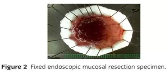 日本消化器内视镜学会结直肠ESD/EMR指南2015版（下）