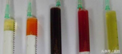 膝盖积水什么颜色，病就是什么样的