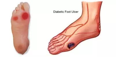 糖尿病足溃烂怎么治疗最有效,糖尿病足反复溃烂是什么原因