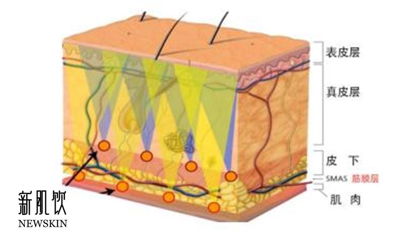 超声刀效果怎么样,超声刀效果最好时间