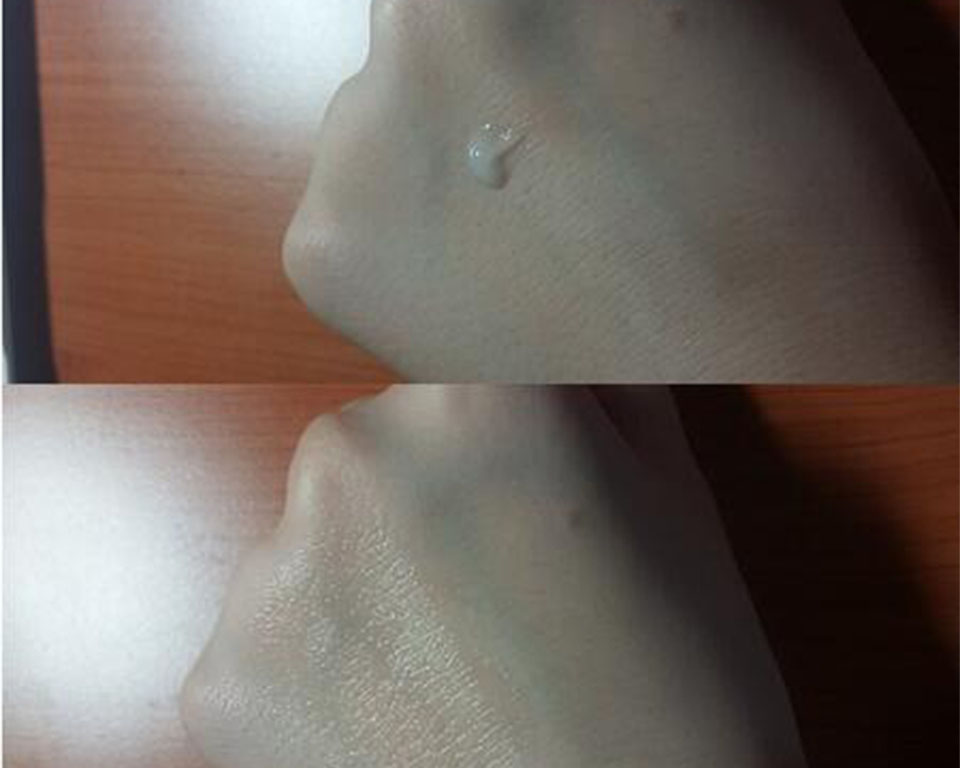 脖子后面长痘痘吃什么药,脖子后面头发长痘痘