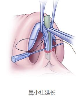 蒜头鼻鼻基底凹陷嘴凸,蒜头鼻和鹰钩鼻图片