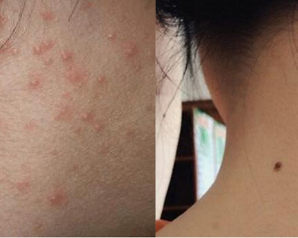 脖子后面长痘痘吃什么药,脖子后面头发长痘痘