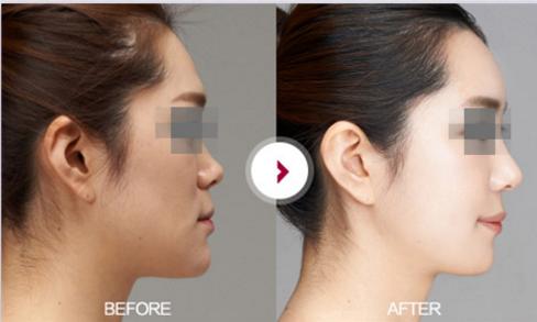 蒜头鼻鼻基底凹陷嘴凸,蒜头鼻和鹰钩鼻图片