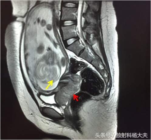 怀孕初期一直流血会是宫颈癌吗,怀孕出血会跟宫颈癌有关吗