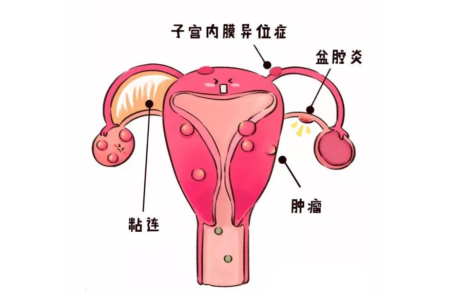 少女痛经，结婚生娃之后就好了？