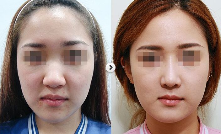 鼻翼缩小鼻子更大,让鼻翼缩小的方法