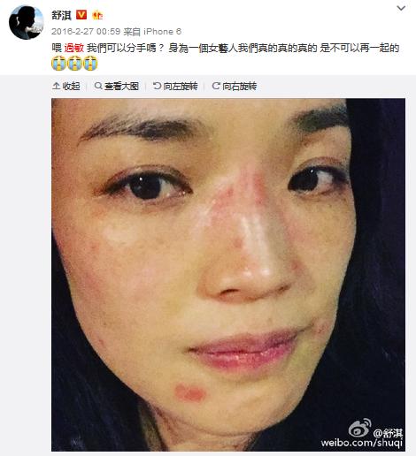 舒淇过敏修复方法,舒淇敏感肌自救方法