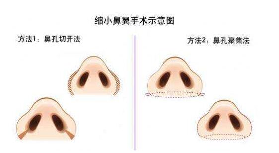 鼻翼缩小鼻子更大,让鼻翼缩小的方法