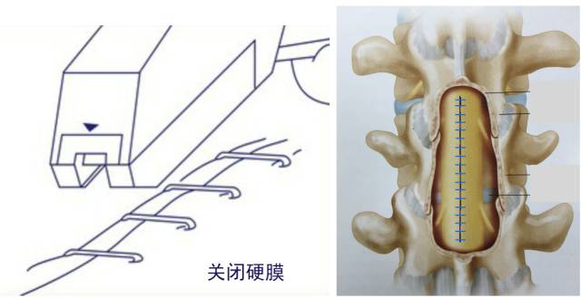 腰腿疼是椎管肿瘤吗,腰腿疼痛需要注意脊髓肿瘤吗