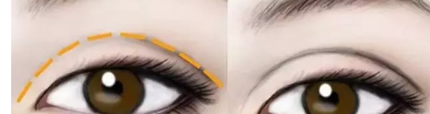 和阿姨的双眼皮做的太宽失败了