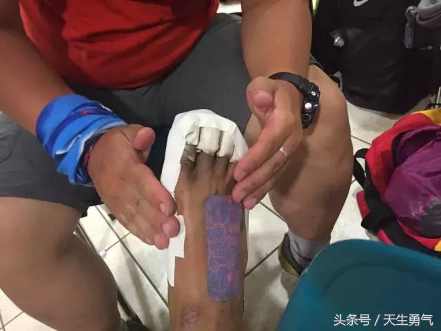 520公里血泪史，要了命的脚底泡