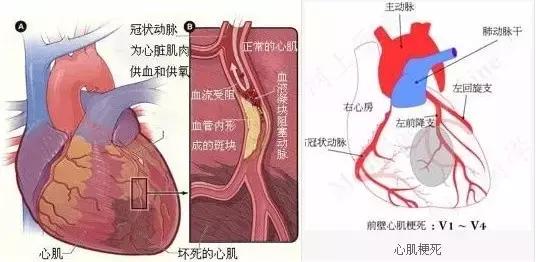 心绞痛在病情发作的时候如何自救,心绞痛和心肌梗塞的症状和区别