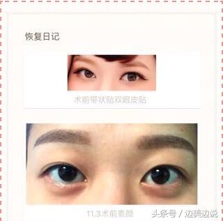 外科医生申霄,申霄医生双眼皮风格