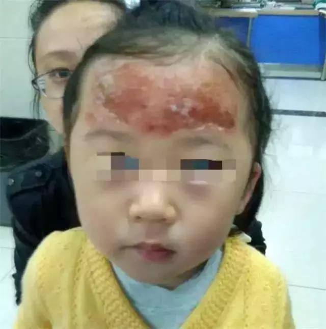 退热贴过敏会全身起红疹吗,退热贴过敏后额头爆皮