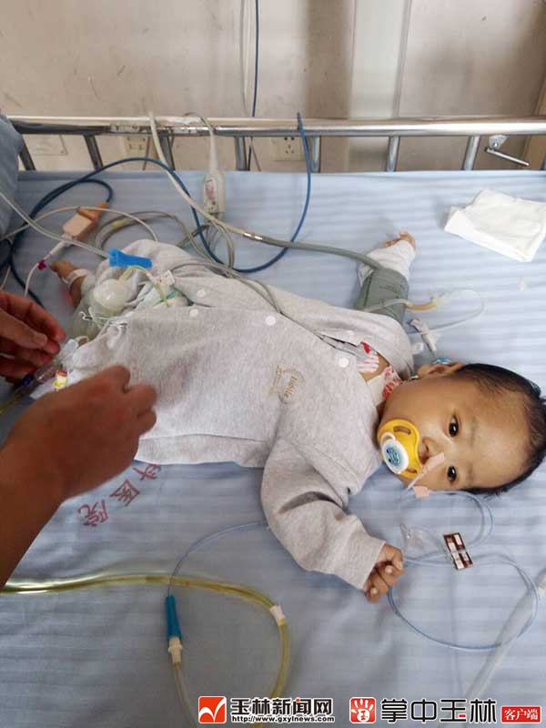 割肝救子女后续,割肝救子手术费用