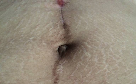 预防妊娠纹的按摩手法,孕期预防妊娠纹的按摩方法