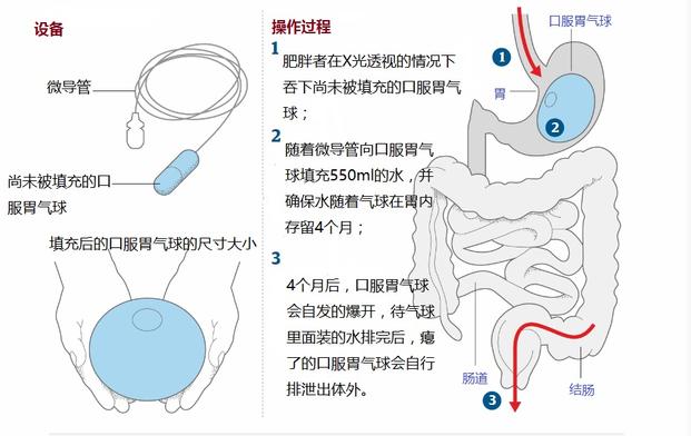 气球减肥最有效的方法,8-16小时减肥法