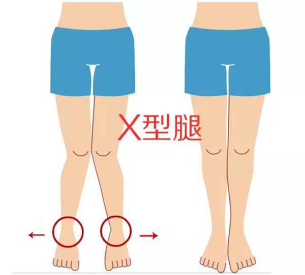 腿型不好看穿短裙怎么办,腿型不好看怎么练