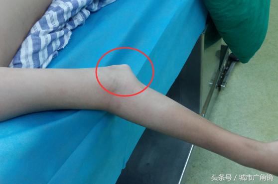 儿童骨折骨头长歪了会自行矫正吗,小孩膝关节骨折后可以恢复正常吗