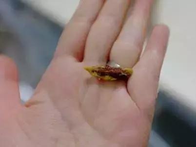 端午节吃粽子被噎死,端午假期西安1医院9例枣核卡食道