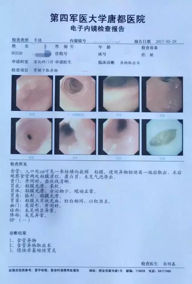 端午节吃粽子被噎死,端午假期西安1医院9例枣核卡食道