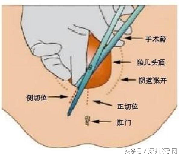 生娃其实没那么痛,顺产侧切的整个过程