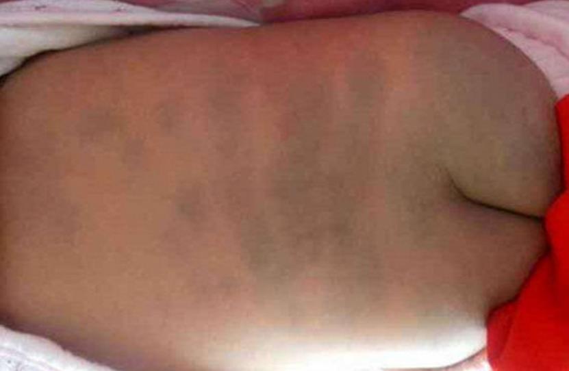 婴儿身上有痣和胎记,婴儿胎记和痣怎么区分