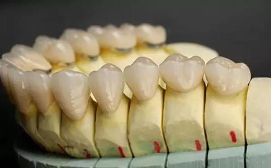 牙医怎么选最好,如何选择适合的烤瓷牙