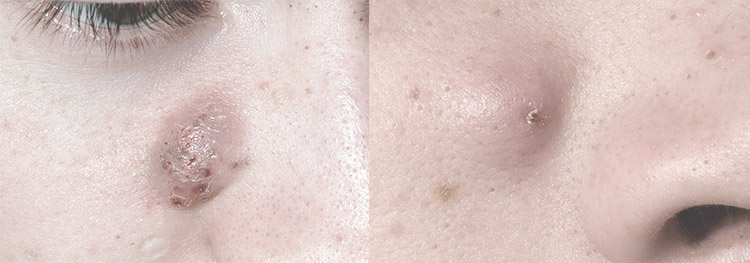 一篇没有噱头不抓眼球但缺切实有用的抗痘护理文章，给有需要的你