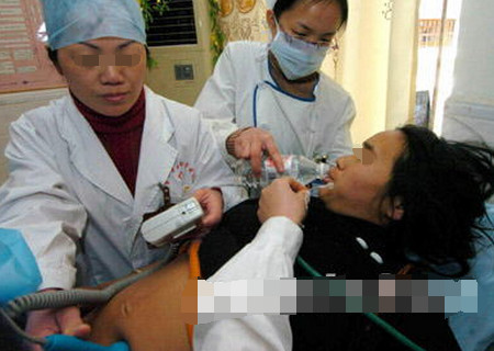 胎儿分娩用吸引器,新生儿难产负压吸引术