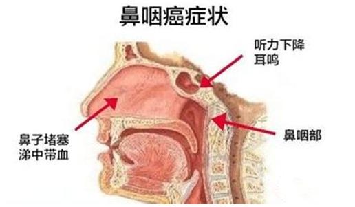 鼻炎与鼻咽癌有关吗？如何有效预防鼻咽癌？