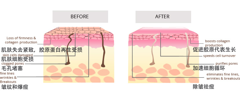 一篇没有噱头不抓眼球但缺切实有用的抗痘护理文章，给有需要的你